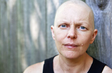 Woman with bald head from cancer treatments